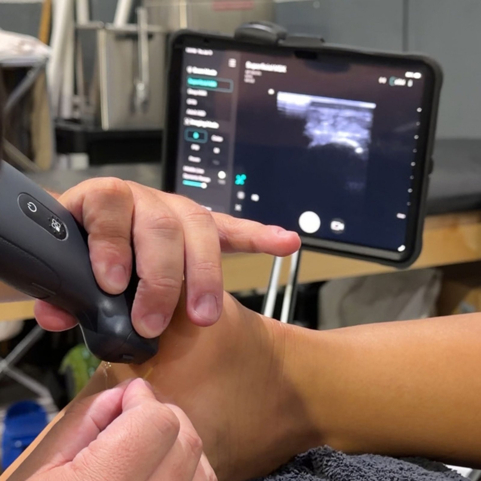 Ultrasound Guided Dry Needling on a patients foot